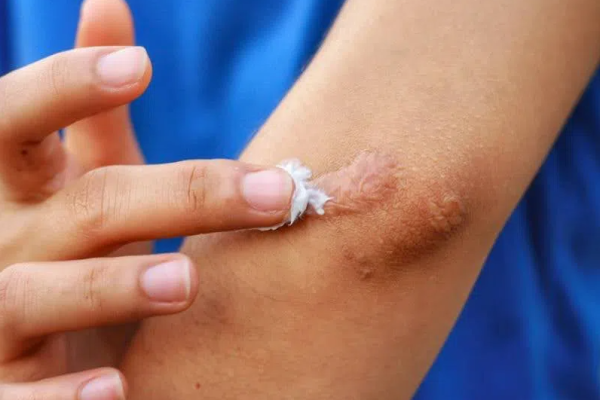 Hướng dẫn bôi kem trị sẹo đúng cách và hiệu quả
